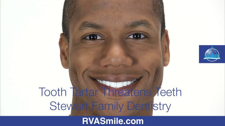 Tooth Tartar Threatens Teeth – Richmond VA Dentist